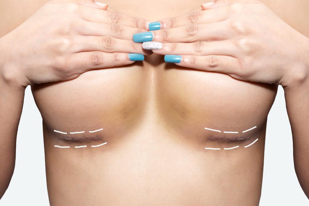 breast revision surgery breast augmentation breast implant removal